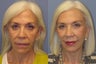 Lite Lift™, brow lift