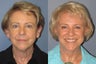 Lite Lift™, brow lift, liposuction of the nec, neck lift, blue peel