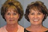 Lite Lift™, neck lift, liposuction of the neck