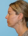Facelift