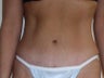 Mini Tummy Tuck