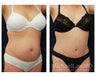 Abdominoplasty - Tummy Tuck