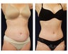 Abdominoplasty - Tummy Tuck