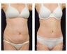 Abdominoplasty - Tummy Tuck