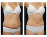 Abdominoplasty - Tummy Tuck
