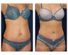 Abdominoplasty - Tummy Tuck