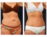 Abdominoplasty - Tummy Tuck
