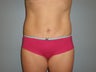 Mini Tummy Tuck 