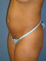 Mini Tummy Tuck
