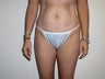 Mini Tummy Tuck