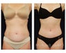 Abdominoplasty - Tummy Tuck