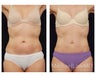 Abdominoplasty - Tummy Tuck