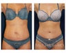 Abdominoplasty - Tummy Tuck