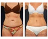 Abdominoplasty - Tummy Tuck