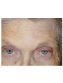 Skin cancer reconstruction