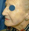 Mohs skin cancer surgery with reconstruction on the cheek