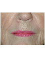 Lip skin cancer reconstruction