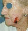 Mohs skin cancer surgery with reconstruction on the cheek