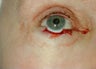 Eyelid skin cancer reconstruction