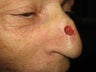 Mohs Surgery