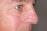 Mohs Surgery