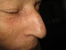 Mohs Surgery