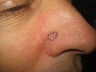 Mohs Surgery