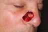 Mohs Surgery