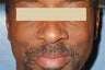 Mole Removal