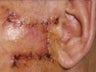 Basal Cell Carcinomas Excisions
