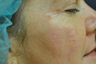 Mole Removal
