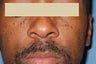 Mole Removal