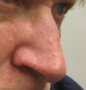 Skin cancer excision with skin graft repair