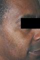Los Angeles Mole Removal - Dermatosis Papulosa Nigra