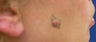 Mole Removal