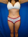 Extened Tummy Tuck (abdominoplasty) and Saline Implants