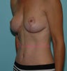 Mommy Makeover (Tummy Tuck and Breast Lift)