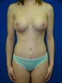 Tummy Tuck Surgery (Abdominoplasty), Breast Lift with Implants