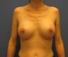 Mommy make over breast augmentation