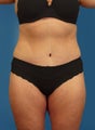 Tummy Tuck
