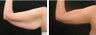 Arm Lift