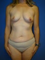 Extended Tummy Tuck (abdominoplasty) with Breast Augmentation Surgery