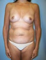 Tummy Tuck Surgery (abdominoplasty) and Augmentation