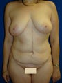 Tummy Tuck, Breast Lift with Implants