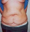 Breast Augmentation with an Abdominoplasty (Tummy Tuck)