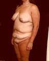 Mommy Makeover