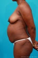 Mommy Makeover: Breast Lift & Extended Abdominoplasty
