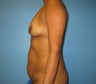 mommy makeover (breast augmentation and tummy tuck)