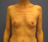 Mommy make over breast augmentation