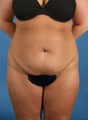 Tummy Tuck